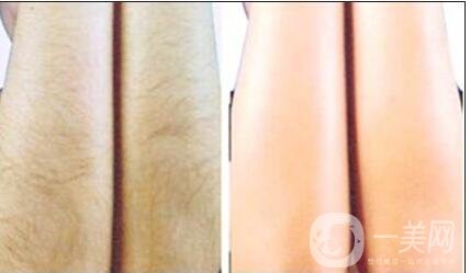 深圳,激光脫毛,價(jià)格