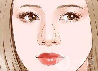 怎么縮小鼻翼？縮小鼻翼術后護理