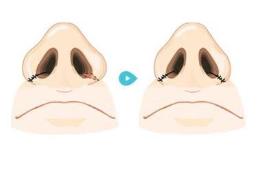 鼻翼縮小術(shù)是*的嗎？