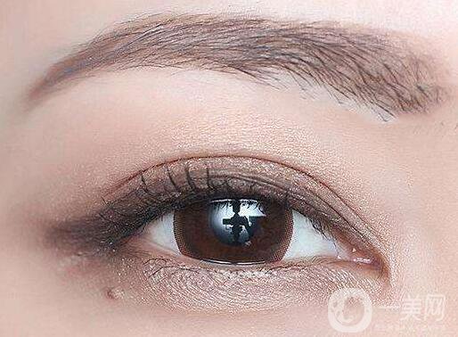 全切雙眼皮能維持多久？