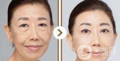 塑美極*果怎么樣？塑美極的副作用