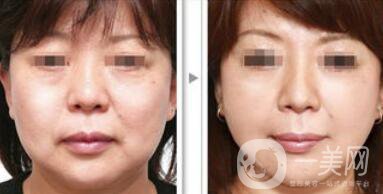 塑美極*果怎么樣？塑美極的副作用