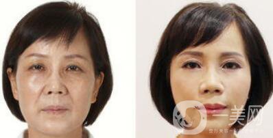 塑美極*果怎么樣？塑美極的副作用