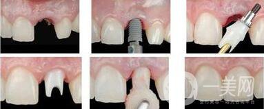 廣州做種植牙價多少錢？費(fèi)用高嗎