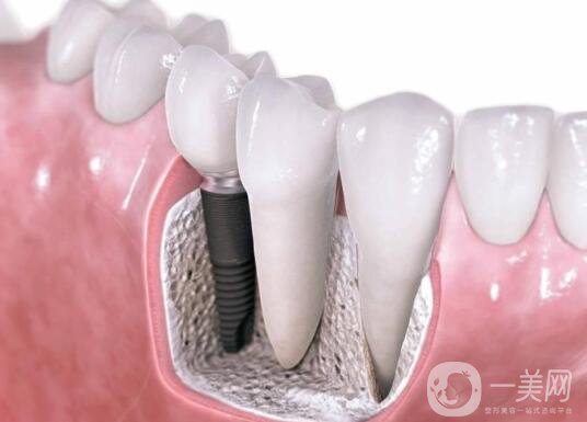 廣州做種植牙價多少錢？費(fèi)用高嗎