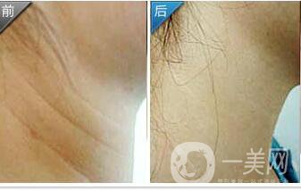 內(nèi)窺鏡除皺,*果怎么樣,術(shù)后如何護(hù)理