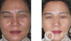 小切口拉皮除皺術(shù)能維持幾年