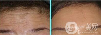 *注射去皺多久見(jiàn)*