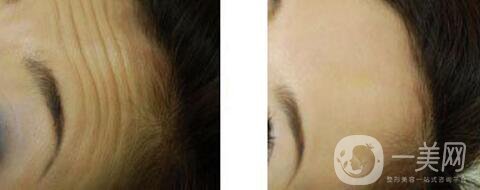 *注射去皺多久見(jiàn)*