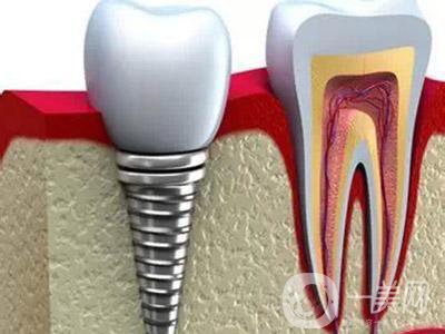 北京種植牙多少錢 種植牙過(guò)程和原理