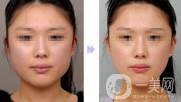 重慶做削骨瘦臉手術(shù)多少錢