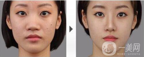 做完*術(shù)后能吃牛肉嗎