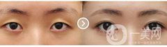 割雙眼皮對(duì)眼睛有什么壞處