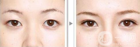 割雙眼皮對(duì)眼睛有什么壞處