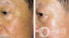 老年斑是如何產(chǎn)生的？怎么去老年斑