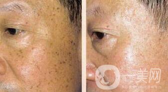 老年斑是如何產(chǎn)生的？怎么去老年斑