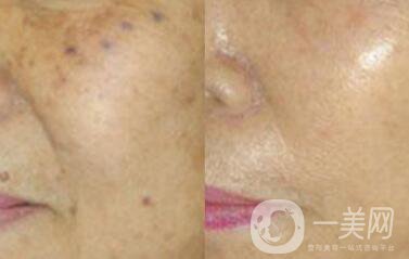 老年斑是如何產(chǎn)生的？怎么去老年斑