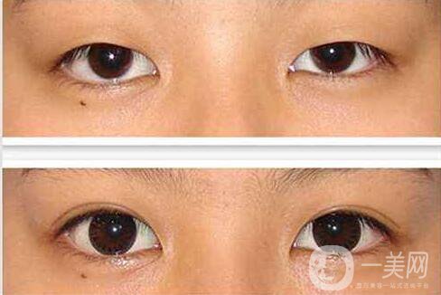 北京,雙眼皮,整形,價(jià)格