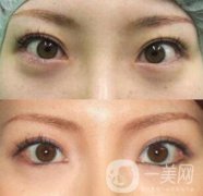 眼臉下至老了會(huì)怎么樣?會(huì)變下垂嗎?