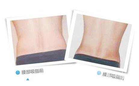 腰腹吸脂,*果呢,多久見*