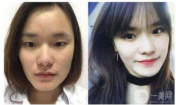 割雙眼皮要注意什么 雙眼皮手術(shù)分析