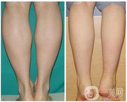 成都注射*瘦腿多少錢 會不會反彈