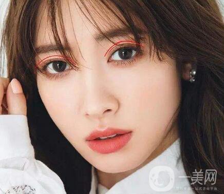 焊接雙眼皮是什么？多久能好？