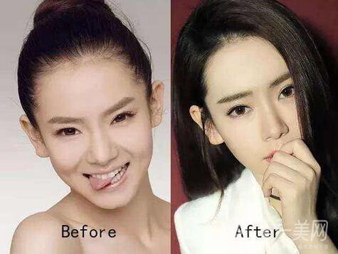 焊接雙眼皮是什么？多久能好？