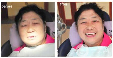 鄭州種植牙價(jià)格多少錢