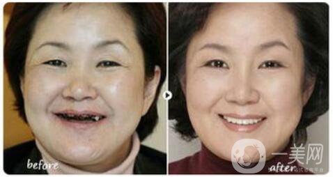 昆山種植牙價格要多少錢