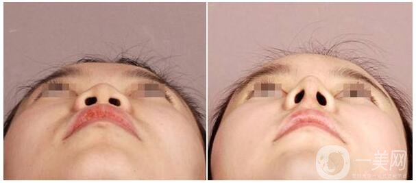 *術后能吃牛肉嗎 *手術后要注意什么