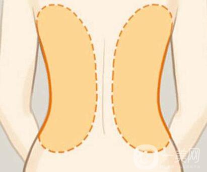 后背抽脂*果*嗎？