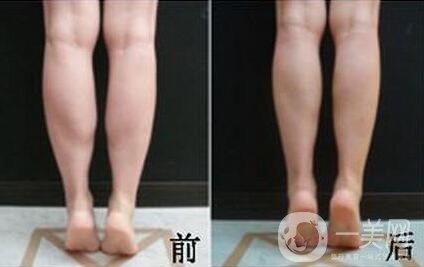 *注射瘦小腿*果怎么樣？