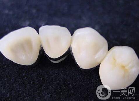 非貴金屬烤瓷牙好不好