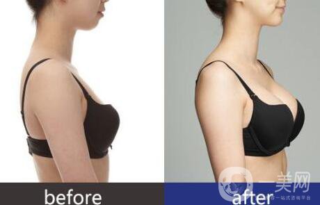 妙桃假體豐胸手術(shù)*果怎么樣
