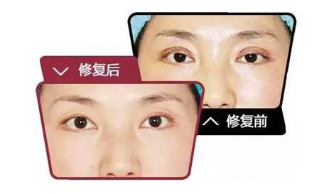 雙眼皮,雙眼皮失敗修復(fù)