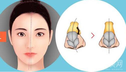 歪鼻矯正手術(shù)多少錢？