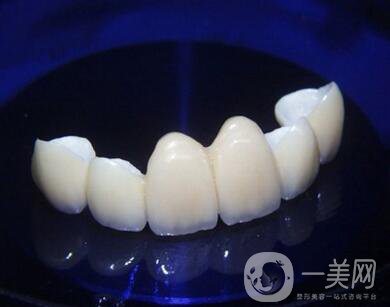 金鈀合金烤瓷牙價(jià)格多少錢？