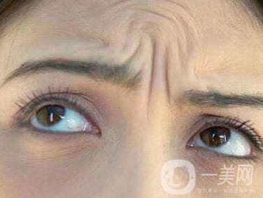 抬頭紋能消除嗎？有哪些方法？