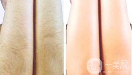 彩光脫毛會(huì)不會(huì)有副作用？