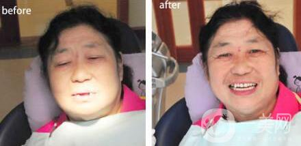 上海,種植牙,介紹