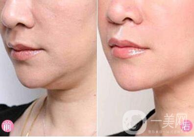 去掉雙下巴多少錢？