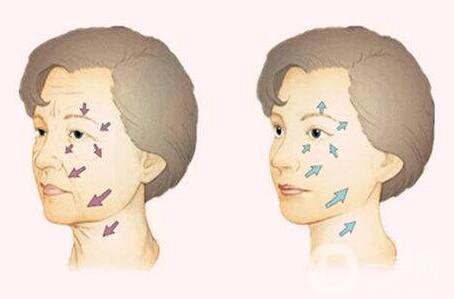 等離子除皺副作用有哪些？