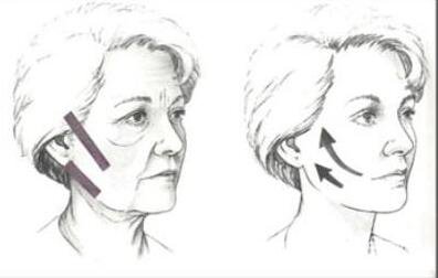 上海,除皺,多少錢