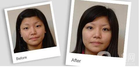 雙眼皮失敗修復(fù),方式