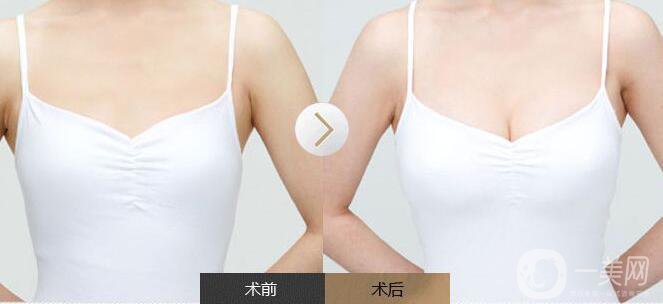 豐胸手術(shù),缺點(diǎn)