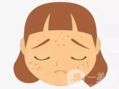 怎么樣*去痘坑 去痘坑方法介紹