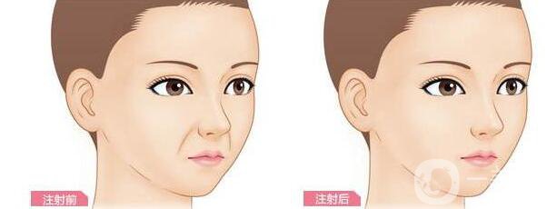 重慶,自體脂肪豐鼻唇溝,優(yōu)勢