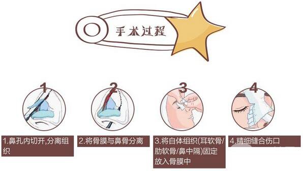 成都肋軟骨隆鼻價格需要多少錢