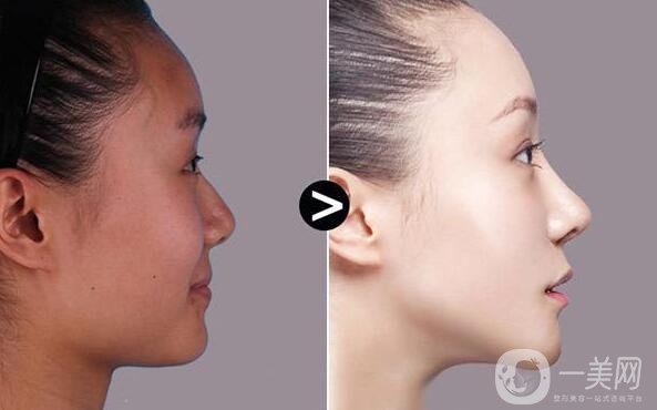 成都肋軟骨隆鼻價格需要多少錢